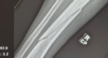 X-ray of fractured tibia